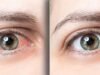 फ्लोटर्स और फ्लैशेस: आँखों में दिखाई देने वाले संकेत जो नज़रअंदाज न करें