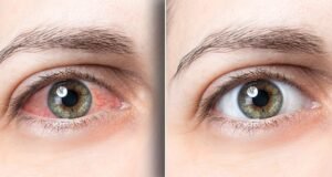 फ्लोटर्स और फ्लैशेस: आँखों में दिखाई देने वाले संकेत जो नज़रअंदाज न करें