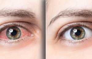 फ्लोटर्स और फ्लैशेस: आँखों में दिखाई देने वाले संकेत जो नज़रअंदाज न करें