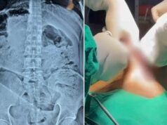 अंबेडकर नगर में हैरान करने वाला मामला: युवक के पेट से सर्जरी कर निकाली गई बोतल, डॉक्टरों ने बचाई जान