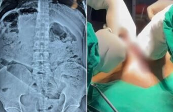 अंबेडकर नगर में हैरान करने वाला मामला: युवक के पेट से सर्जरी कर निकाली गई बोतल, डॉक्टरों ने बचाई जान